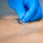 How to Find the Best Dry Needling Therapist in Adelaide