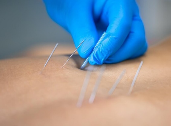 How to Find the Best Dry Needling Therapist…